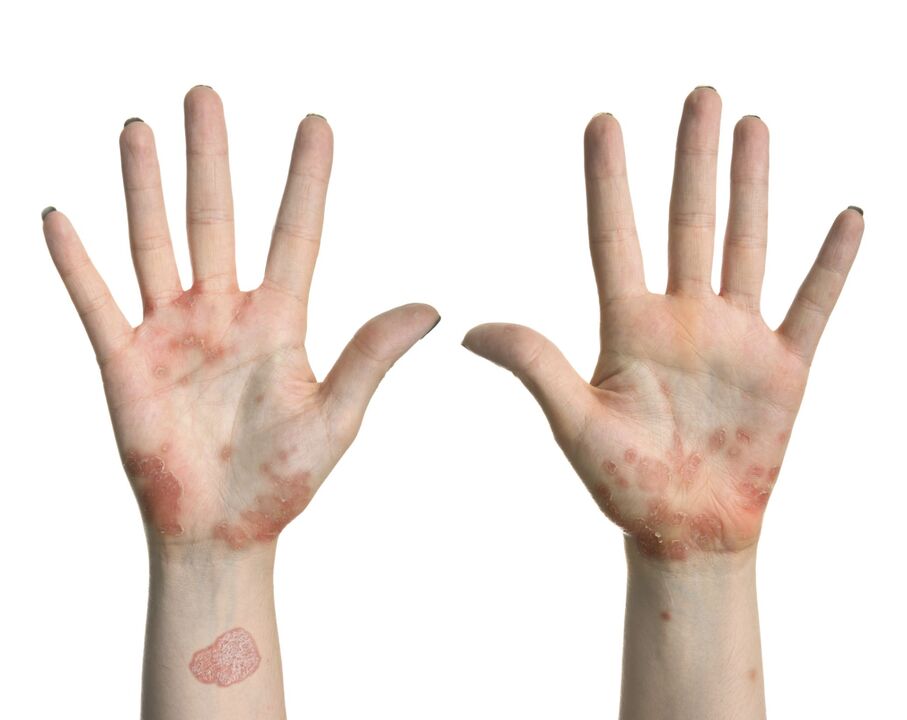 Psoriasis a kezeken